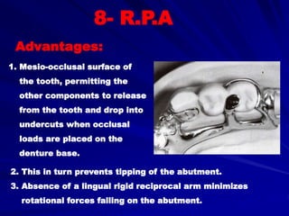 Reciprocal Tooth B- Retention of Removable Partial Dentures | PPT