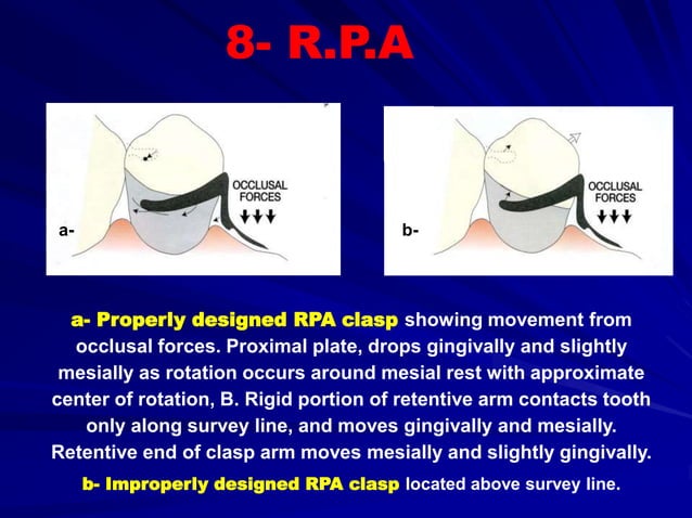 B- Retention of Removable Partial Dentures | PPT | Oral care | Personal ...