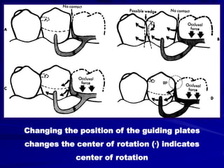Pdrub Chief Rotation Plate B- Retention of Removable Partial Dentures | PPT