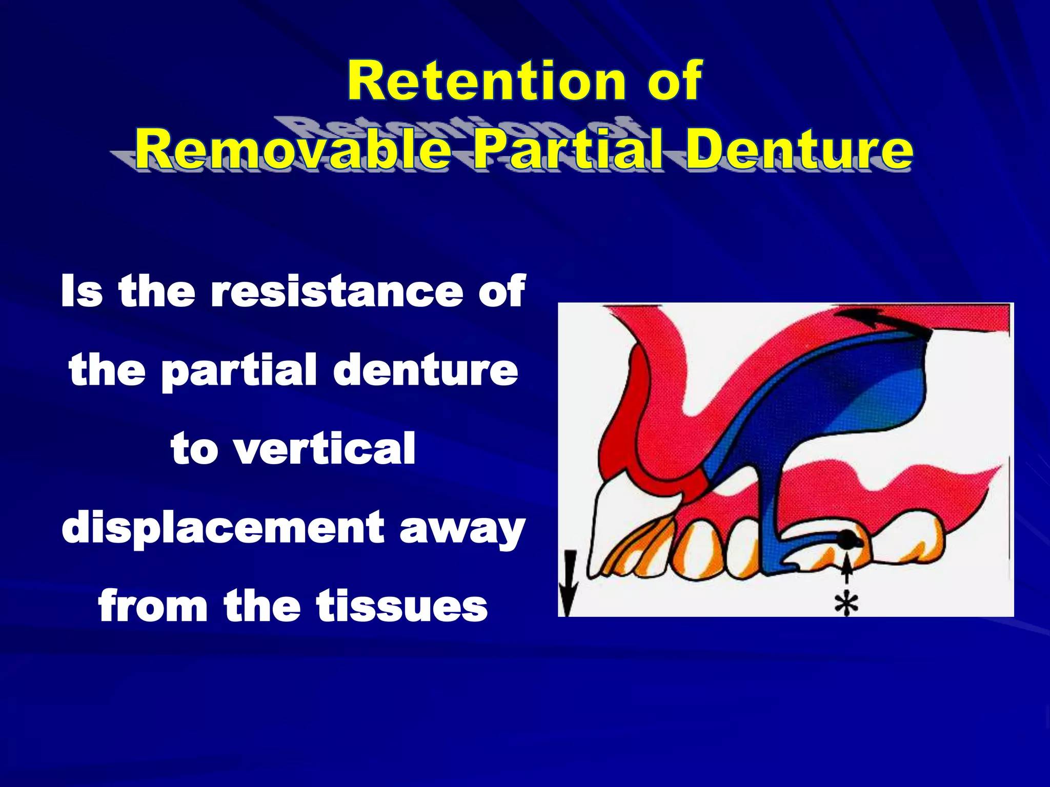 b- Retainers of RPDs | PPT