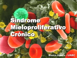 Síndrome  Mieloproliferativo  Crónico Blanca Acosta - UABC 