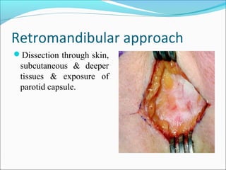 Retromandibular approach
Dissection through skin,
subcutaneous & deeper
tissues & exposure of
parotid capsule.
 