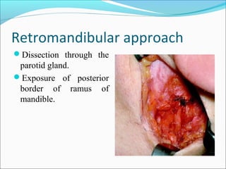 Retromandibular approach
Dissection through the
parotid gland.
Exposure of posterior
border of ramus of
mandible.
 