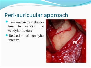 Peri-auricuular approach
Trans-messeteric dissec-
tion to expose the
condylar fracture
Reduction of condylar
fracture
 