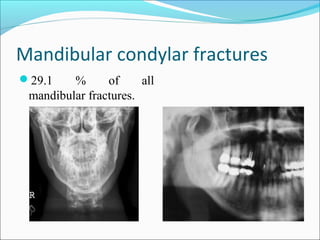 Mandibular condylar fractures
29.1 % of all
mandibular fractures.
 