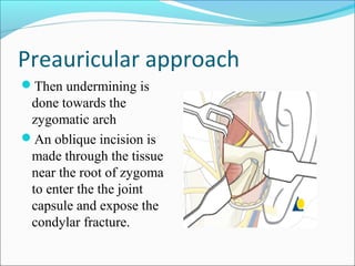 Preauricular approach
Then undermining is
done towards the
zygomatic arch
An oblique incision is
made through the tissue
near the root of zygoma
to enter the the joint
capsule and expose the
condylar fracture.
 