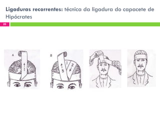 Ligaduras recorrentes: técnica da ligadura do capacete de
Hipócrates
20

 