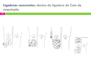 Ligaduras recorrentes: técnica da ligadura do Coto de
amputação
23

 