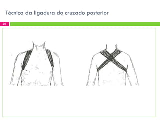 Técnica da ligadura do cruzado posterior
26

 