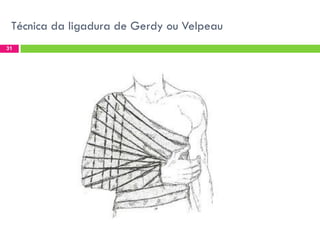 Técnica da ligadura de Gerdy ou Velpeau
31

 