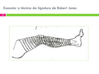 Executar a técnica da ligadura de Robert Jones
34

 