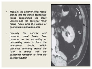 • Medially the anterior renal fascia
blends into the dense connective
tissue surrounding the great
vessels and the posterior renal
fascia fuses with the psoas or
quadratus lumborum fascia
• Laterally the anterior and
posterior renal fascia fuse
posterior to the ascending or
descending colon to form the
lateroconal fascia, which
continues anteriorly around the
flank to merge with the
peritoneal reflection to form the
paracolic gutter
 