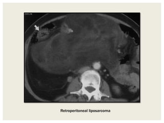 Retroperitoneal liposarcoma
 