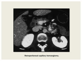 Retroperitoneal capillary hemangioma.
 