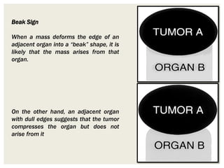 Beak Sign
When a mass deforms the edge of an
adjacent organ into a “beak” shape, it is
likely that the mass arises from that
organ.
On the other hand, an adjacent organ
with dull edges suggests that the tumor
compresses the organ but does not
arise from it
 