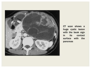 CT scan shows a
huge cystic lesion
with the beak sign
in its contact
surface with the
pancreas
 