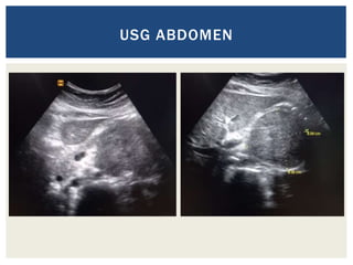USG ABDOMEN
 