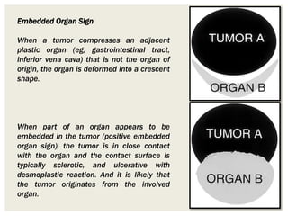 Embedded Organ Sign
When a tumor compresses an adjacent
plastic organ (eg, gastrointestinal tract,
inferior vena cava) that is not the organ of
origin, the organ is deformed into a crescent
shape.
When part of an organ appears to be
embedded in the tumor (positive embedded
organ sign), the tumor is in close contact
with the organ and the contact surface is
typically sclerotic, and ulcerative with
desmoplastic reaction. And it is likely that
the tumor originates from the involved
organ.
 