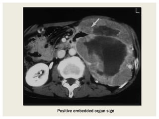 Positive embedded organ sign
 