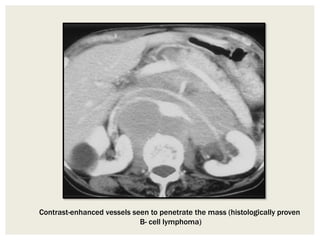 Contrast-enhanced vessels seen to penetrate the mass (histologically proven
B- cell lymphoma)
 