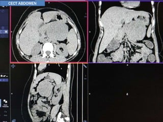 CECT ABDOMEN
 