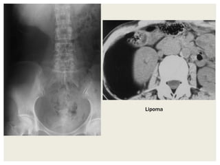 Lipoma
 
