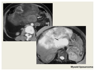 Myxoid liposarcoma
 