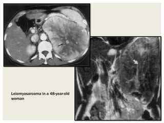 Leiomyosarcoma in a 48-year-old
woman
 
