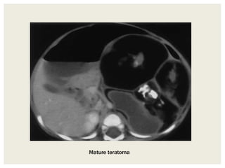 Mature teratoma
 