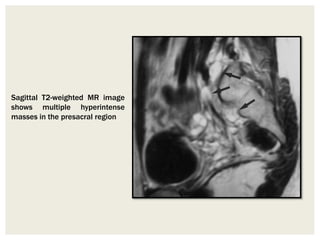 Sagittal T2-weighted MR image
shows multiple hyperintense
masses in the presacral region
 