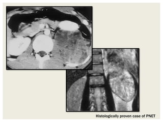 Histologically proven case of PNET
 