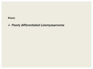 Biopsy:
 Poorly differentiated Leiomyosarcoma
 