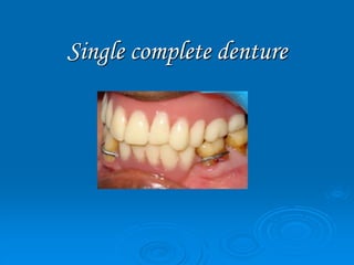 Single complete denture
 