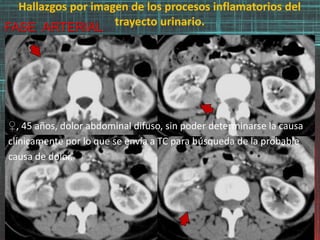 Hallazgos por imagen de los procesos inflamatorios del
trayecto urinario.FASE ARTERIAL
♀, 45 años, dolor abdominal difuso, sin poder determinarse la causa
clínicamente por lo que se envía a TC para búsqueda de la probable
causa de dolor.
 
