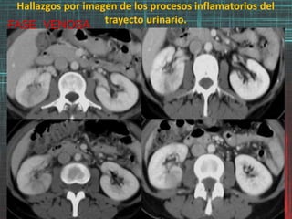 Hallazgos por imagen de los procesos inflamatorios del
trayecto urinario.FASE VENOSA
 