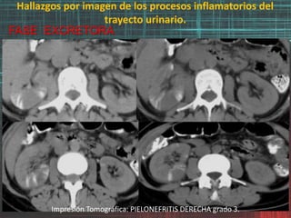 Hallazgos por imagen de los procesos inflamatorios del
trayecto urinario.
FASE EXCRETORA
Impresión Tomográfica: PIELONEFRITIS DERECHA grado 3.
 