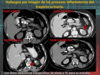 Hallazgos por imagen de los procesos inflamatorios del
trayecto urinario.
FASE SIMPLE FASE ARTERIAL
FASE VENOSA FASE EXCRECION
♀ con dolor abdominal inespecífico. Se envía a TC para su estudio.
 