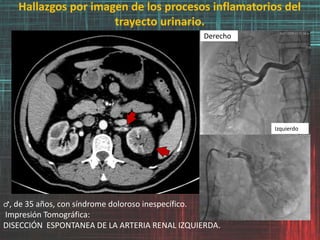 Hallazgos por imagen de los procesos inflamatorios del
trayecto urinario.
♂, de 35 años, con síndrome doloroso inespecífico.
Impresión Tomográfica:
DISECCIÓN ESPONTANEA DE LA ARTERIA RENAL IZQUIERDA.
Derecho
Izquierdo
 