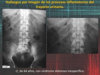 Hallazgos por imagen de los procesos inflamatorios del
trayecto urinario.
♂, de 64 años, con síndrome doloroso inespecífico.
 
