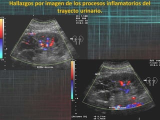 Hallazgos por imagen de los procesos inflamatorios del
trayecto urinario.
 