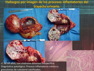 Hallazgos por imagen de los procesos inflamatorios del
trayecto urinario.
♂, de 64 años, con síndrome doloroso inespecífico.
Diagnóstico patológico: Proceso inflamatorio crónico y
granulomas de colesterol calcificados.
 