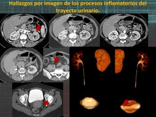 Hallazgos por imagen de los procesos inflamatorios del
trayecto urinario.
 