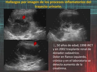 Hallazgos por imagen de los procesos inflamatorios del
trayecto urinario.
♀, 50 años de edad; 1998 IRCT
y en 2002 trasplante renal de
donador cadavérico.
Dolor en flanco izquierdo,
crónico y en el laboratorio se
detecta aumento de la
creatinina.
 