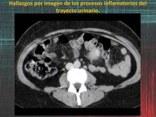 Hallazgos por imagen de los procesos inflamatorios del
trayecto urinario.
 