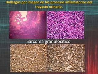 Hallazgos por imagen de los procesos inflamatorios del
trayecto urinario.
Sarcoma granulocítico
 