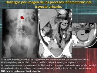 Hallazgos por imagen de los procesos inflamatorios del
trayecto urinario.
♀, 46 años de edad, diabética de larga evolución, mal controlada, con acidosis metabólica.
Aire intrapielico, aire loculado hacia la periferia del parénquima, subcapsular e
intraparenquimatoso, e intraureteral. La RMP define con mayor precisión la extensa afección del
aire pielico izquierdo con la necrosis parenquimatosa renal izquierda, sin colección perirenal.
PNE caracterizada como tipo I, clase 3a.
 