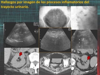 Hallazgos por imagen de los procesos inflamatorios del
trayecto urinario.
 