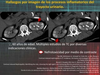 Hallazgos por imagen de los procesos inflamatorios del
trayecto urinario.
♀, 60 años de edad. Múltiples estudios de TC por diversas
indicaciones clínicas.
Nefrotoxicidad por medio de contraste
Tao SM, Wichmann JL, Schoepf UJ, Fuller SR, Lu GM, Zhang LJ.
Contrast-induced nephropathy in CT: incidence, risk factors and strategies for prevention.
Eur Radiol 2016;26:3310–3318.
Nicola R, Shaqdan KW, Aran K, Mansouri M, Singh , Abujudeh H.
Contrast-Induced Nephropathy: Identifying the risks, choosing the right agent, and reviewing effective prevention and management methods.
Current Problems in Diagnostic Radiology 2015; 44:501–504.
Bastida-Alquicira J, Motta-Ramírez GA, Amezquita-Pérez S, Jesús Alfredo Gómez-Vázquez JA.
Donde el arte y la ciencia se unen: la nefropatía inducida por medio de contraste y sus factores de riesgo asociados.
Med Int Méx 2015;31:64-76.
 