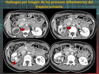 Hallazgos por imagen de los procesos inflamatorios del
trayecto urinario.
 