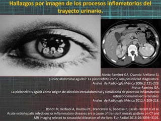 Hallazgos por imagen de los procesos inflamatorios del
trayecto urinario.
Motta-Ramirez GA, Ovando-Arellano EJ.
¿Dolor abdominal agudo?: La pielonefritis como una posibilidad diagnóstica.
Anales de Radiología México 2006;3:221-229.
Motta-Ramirez GA.
La pielonefritis aguda como origen de afección intraabdominal y simuladora de procesos inflamatorios
intraabdominales extrarrenales.
Anales de Radiología México 2012;4:209-218.
Ronot M, Kerbaol A, Rautou PE, Brancatelli G, Bedossa P, Cazals-Hatem D et al.
Acute extrahepatic infectious or inflammatory diseases are a cause of transient mosaic pattern on CT and
MR imaging related to sinusoidal dilatation of the liver. Eur Radiol 2016;26:3094–3101.
 